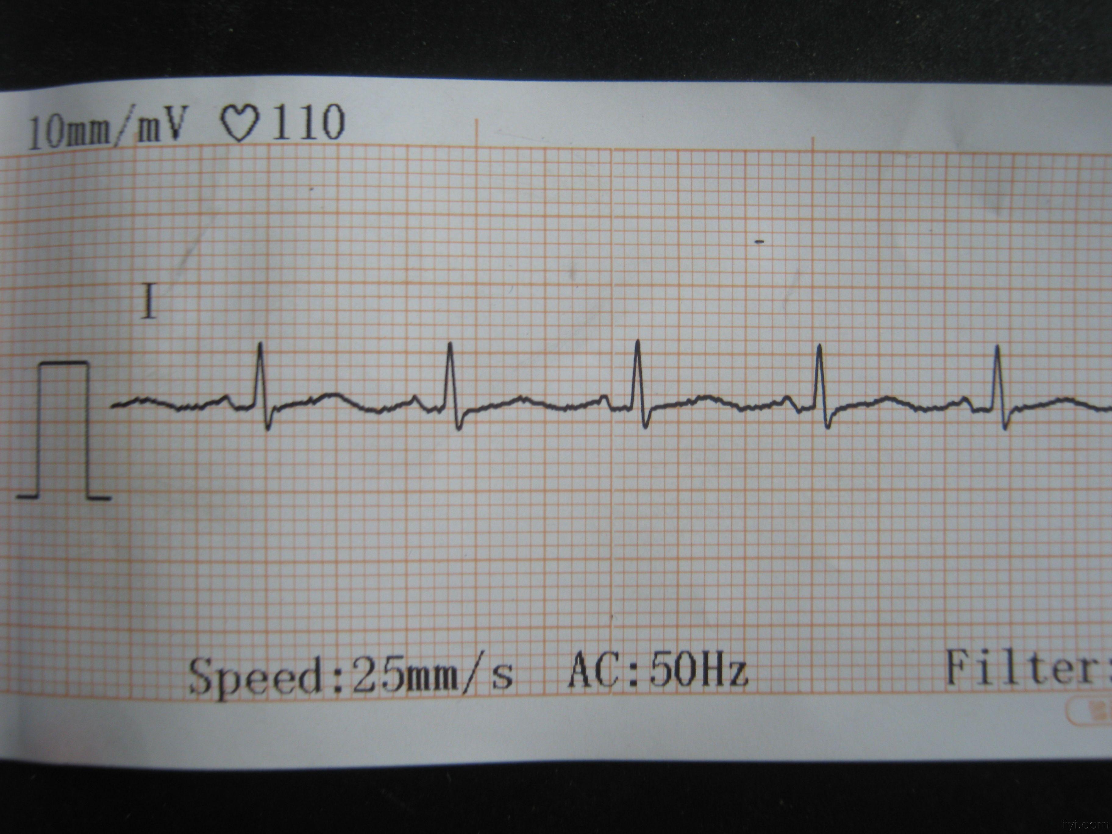 心电图大家帮我分析一下