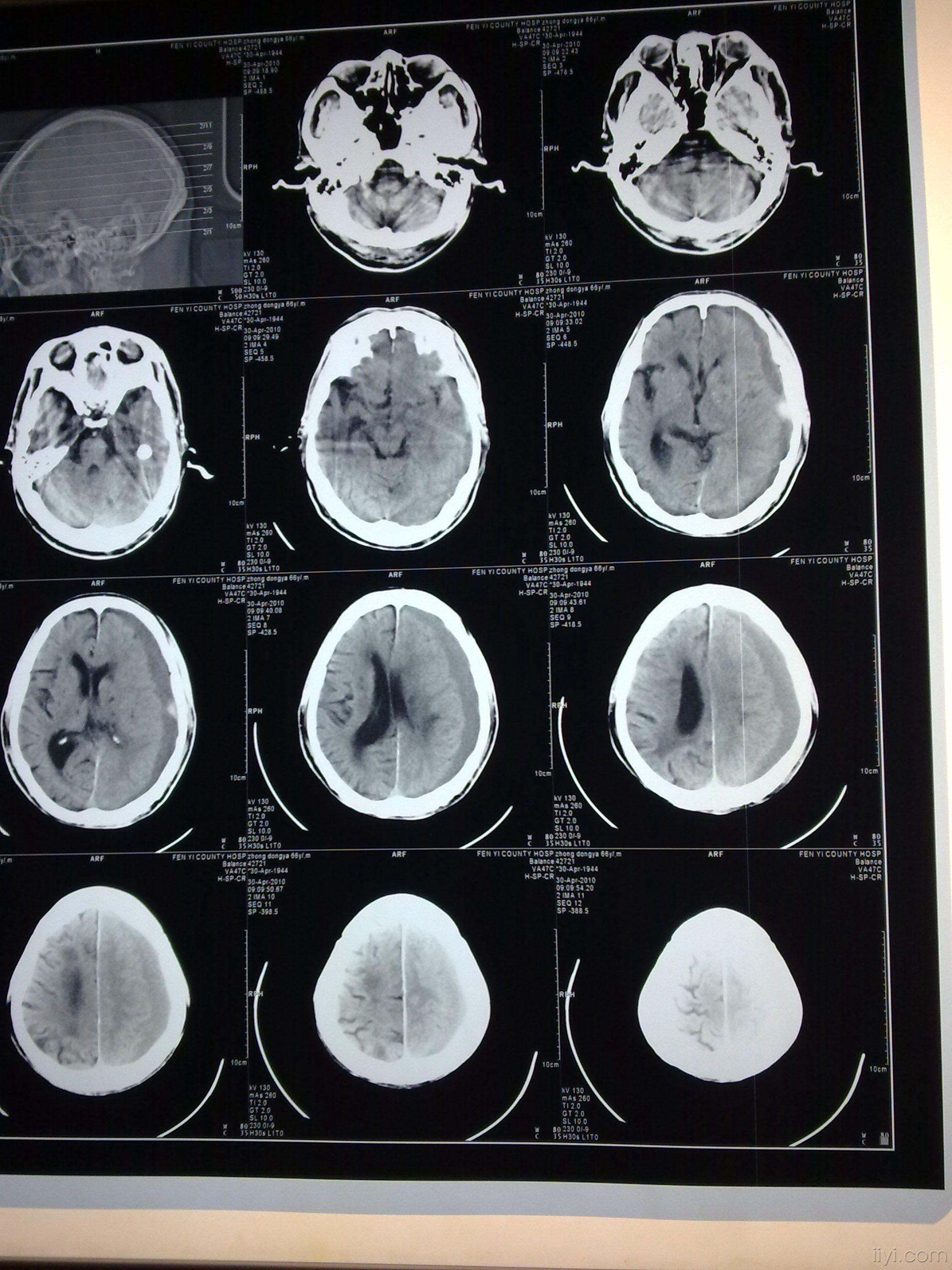 慢性硬膜下血肿再出血