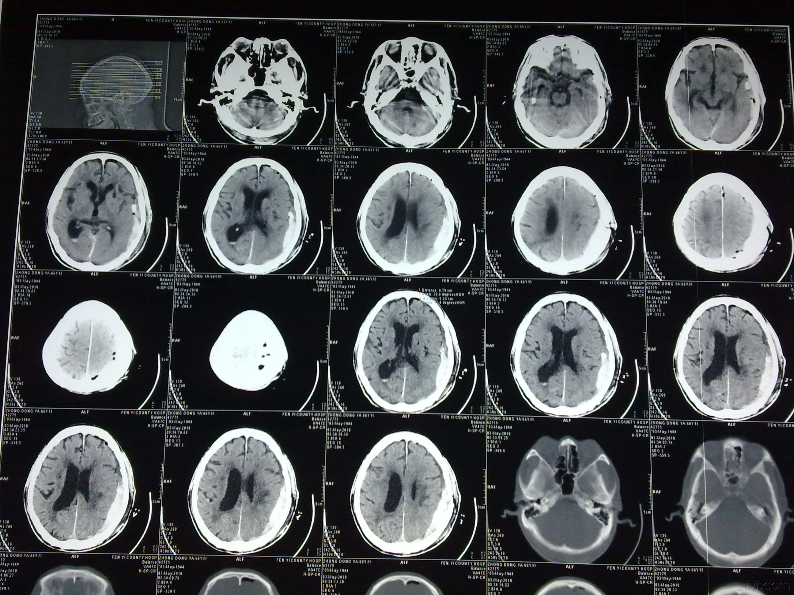 慢性硬膜下血肿再出血 - 神经外科专业讨论版 - 爱爱医医学论坛