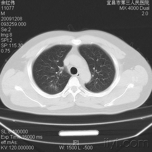 急求教以下病例怎样区分大叶性小叶性肺炎在线等谢谢