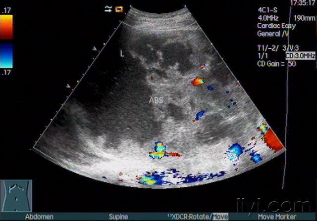超声诊断糖尿病并巨大含气性肝脓肿——zengerya