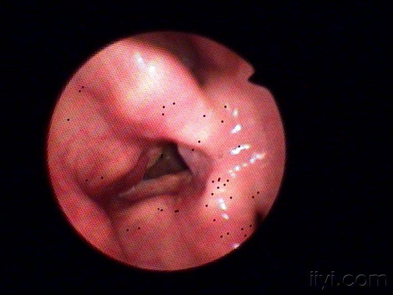 卡鱼刺喉镜图片