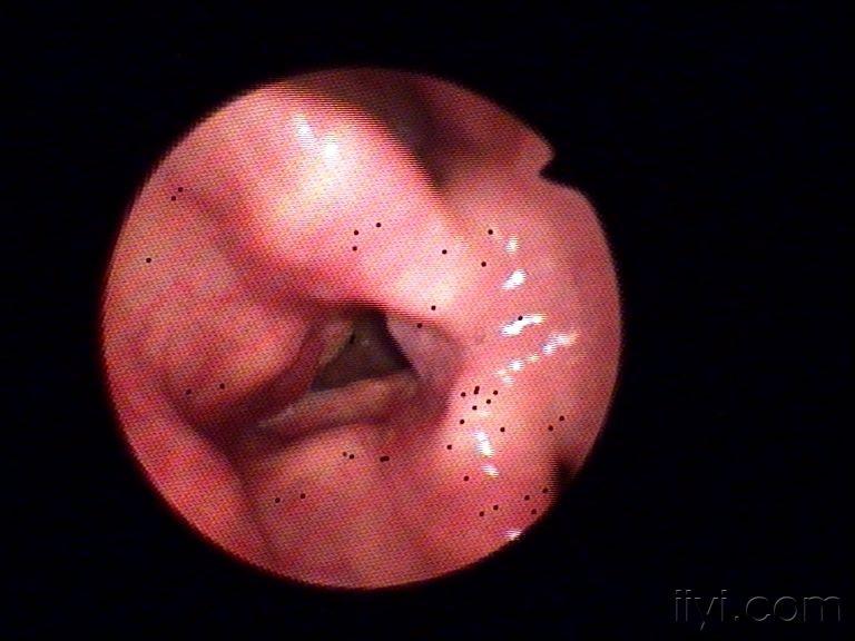 声带小结图片喉镜图片