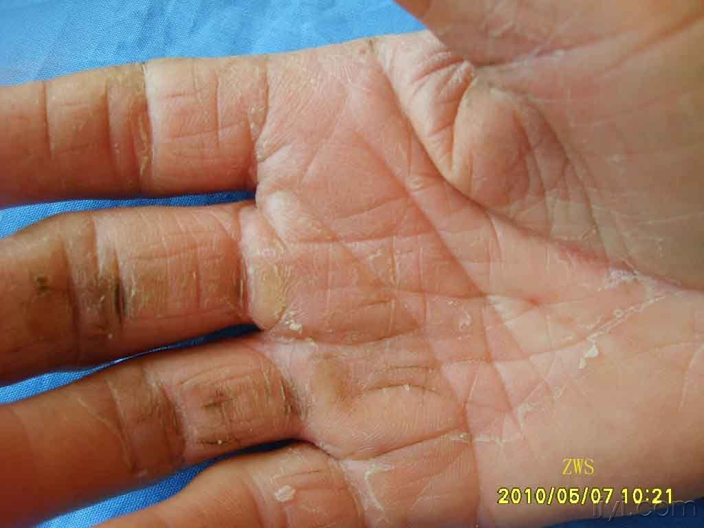 不仔细看很容易误诊的常见病体癣和手癣