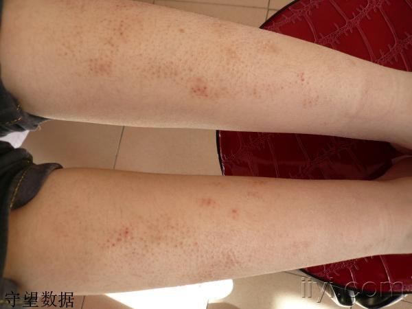 门诊病人(2) - 皮肤及性传播疾病讨论版 - 爱爱医医学论坛