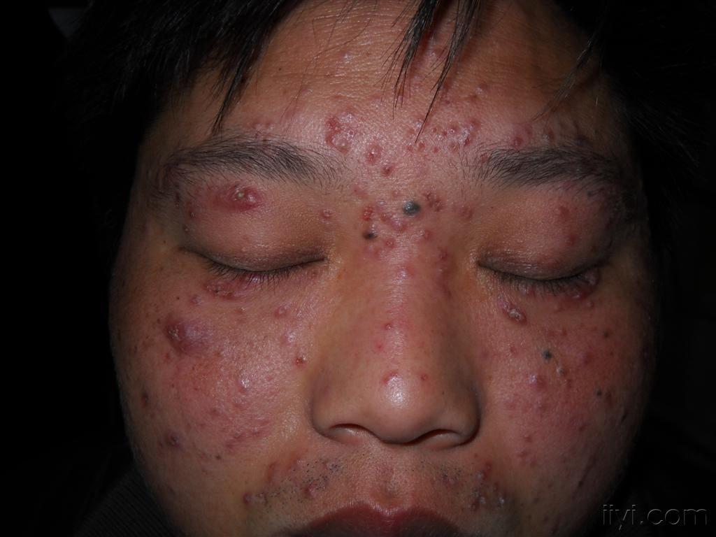 公布答案:颜播 - 皮肤及性传播疾病讨论版 - 爱爱医医学论坛