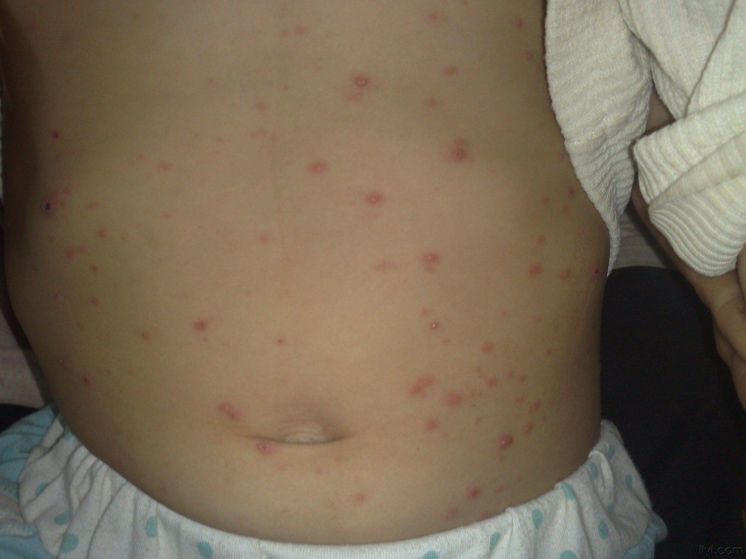 儿童水痘的症状和图片图片