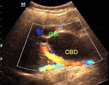 胆总管囊状扩张又称胆总管囊肿-zengerya 超声医学讨论版 爱爱医