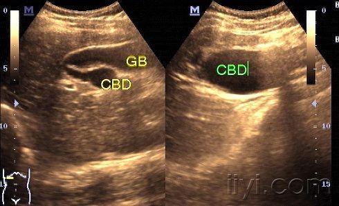 肝内胆管扩张超声图片