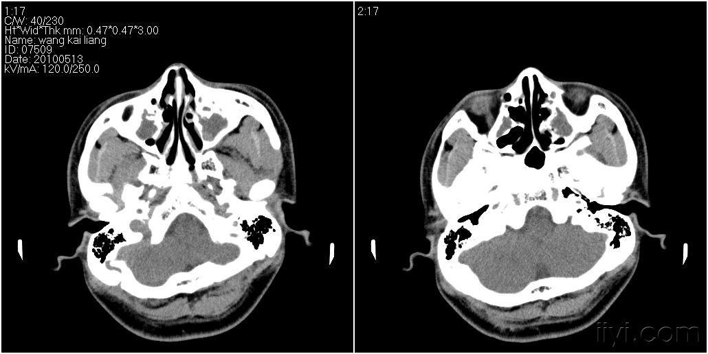男性27岁患者要求头颅扫描发现蝶窦病变