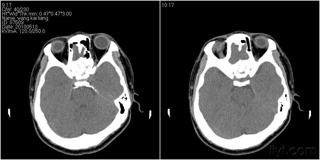 男性27岁患者要求头颅扫描发现蝶窦病变