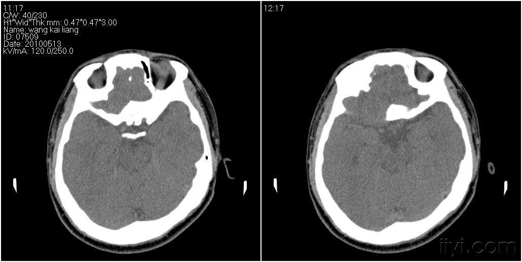 男性27岁患者要求头颅扫描发现蝶窦病变