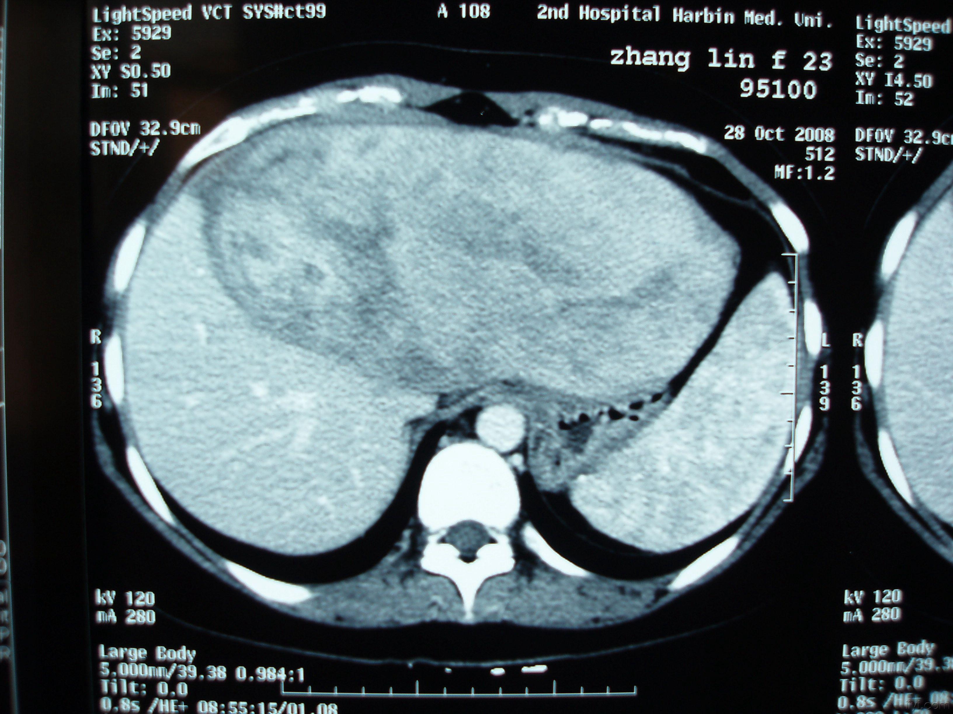 肝血管瘤图片危险图片