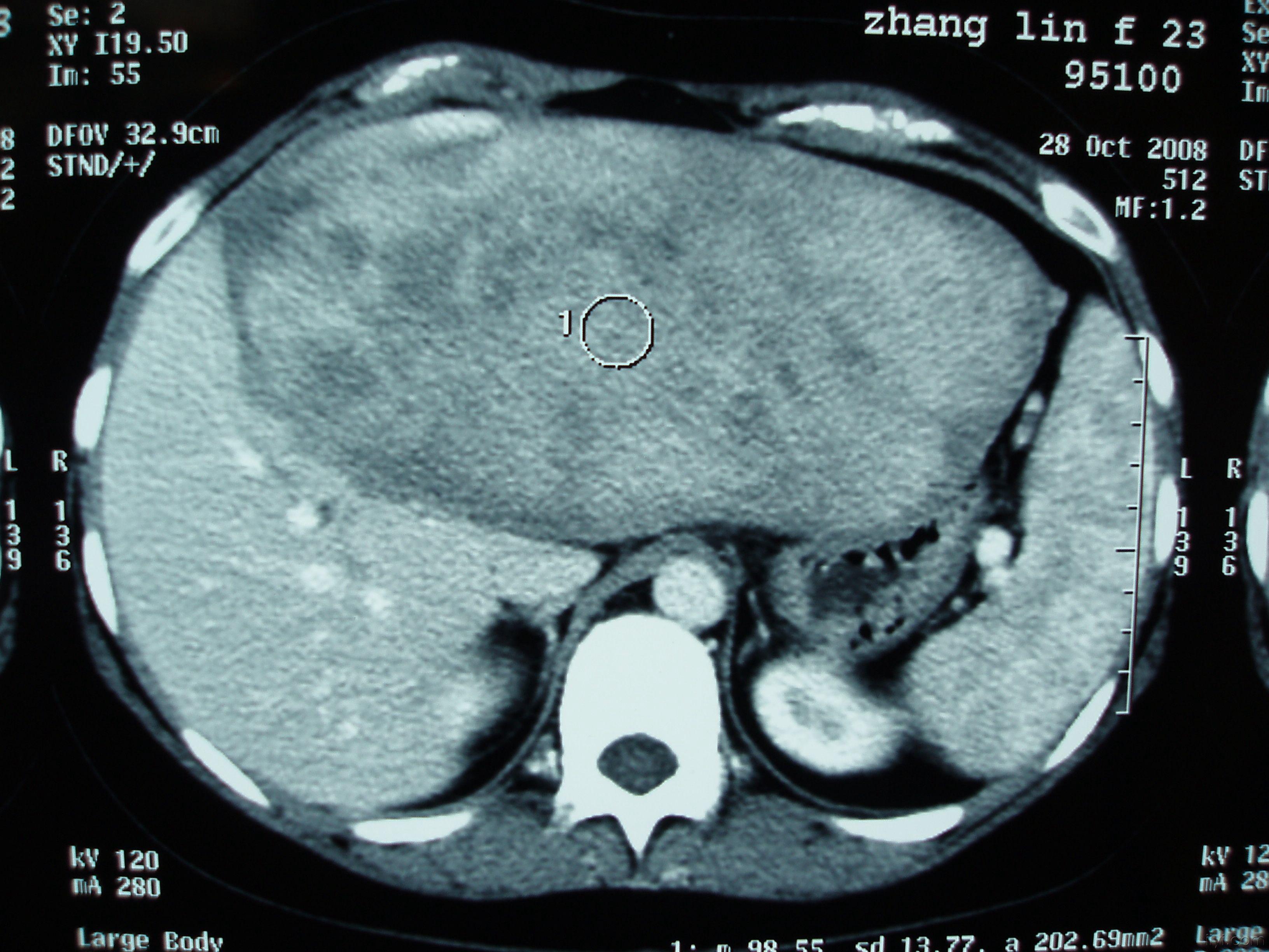 肝脏血管瘤图片 症状图片
