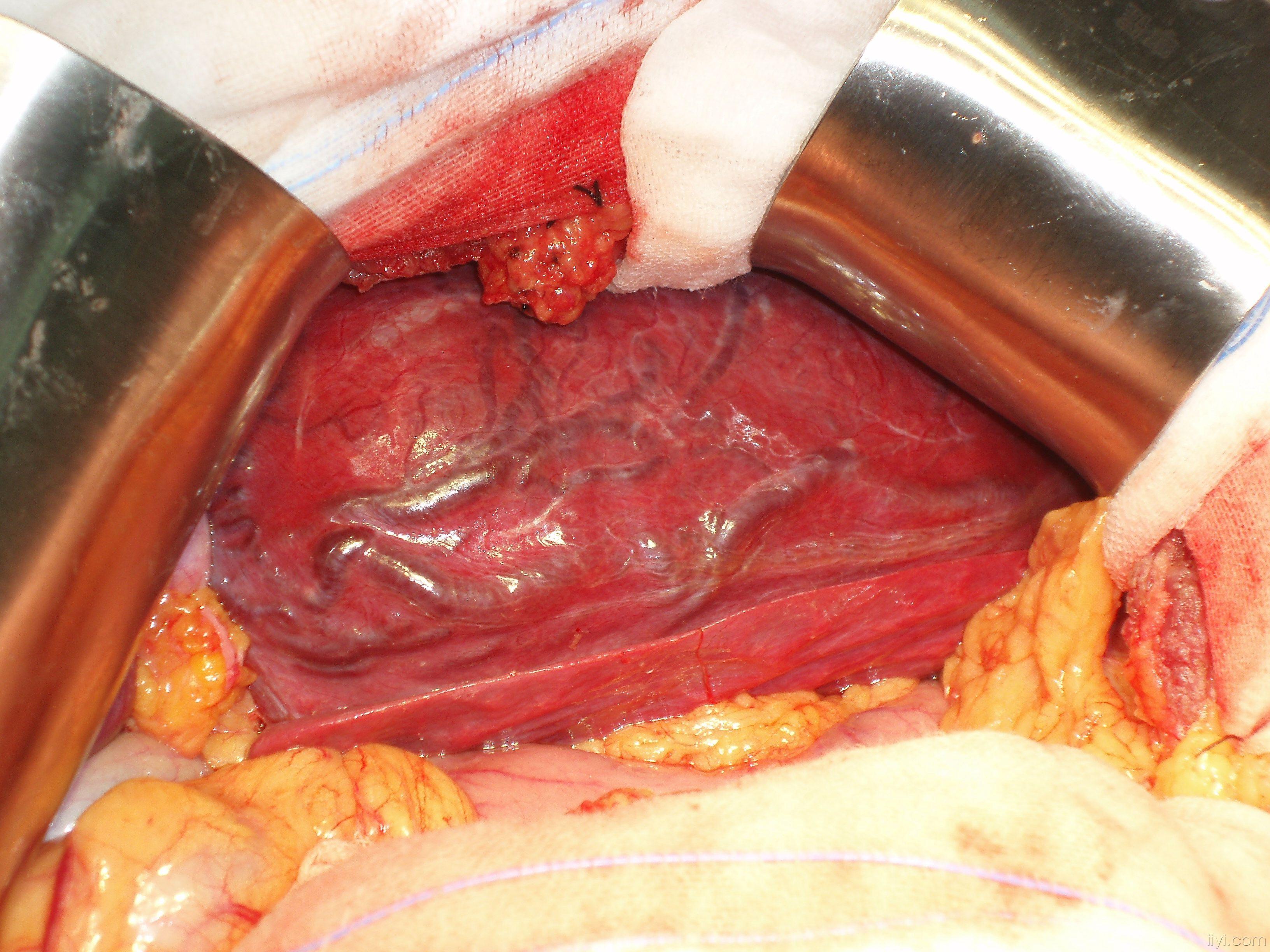 肝血管瘤6cm图片图片