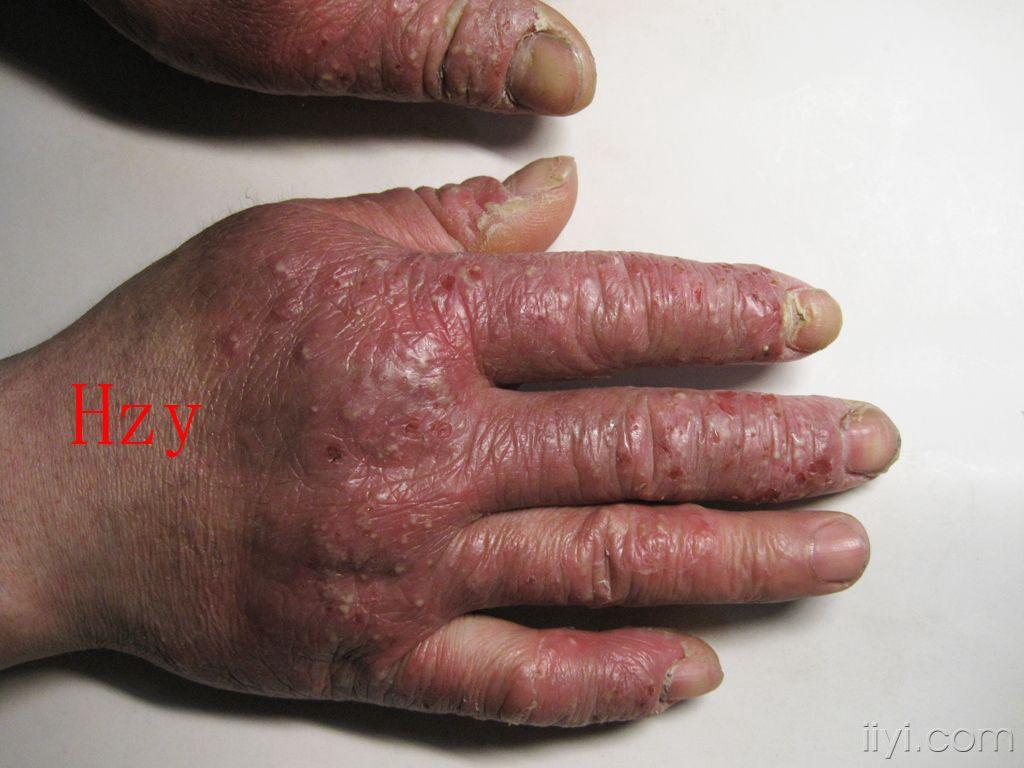 两手背小脓疱反复发作二个多月公布答案接触性皮炎
