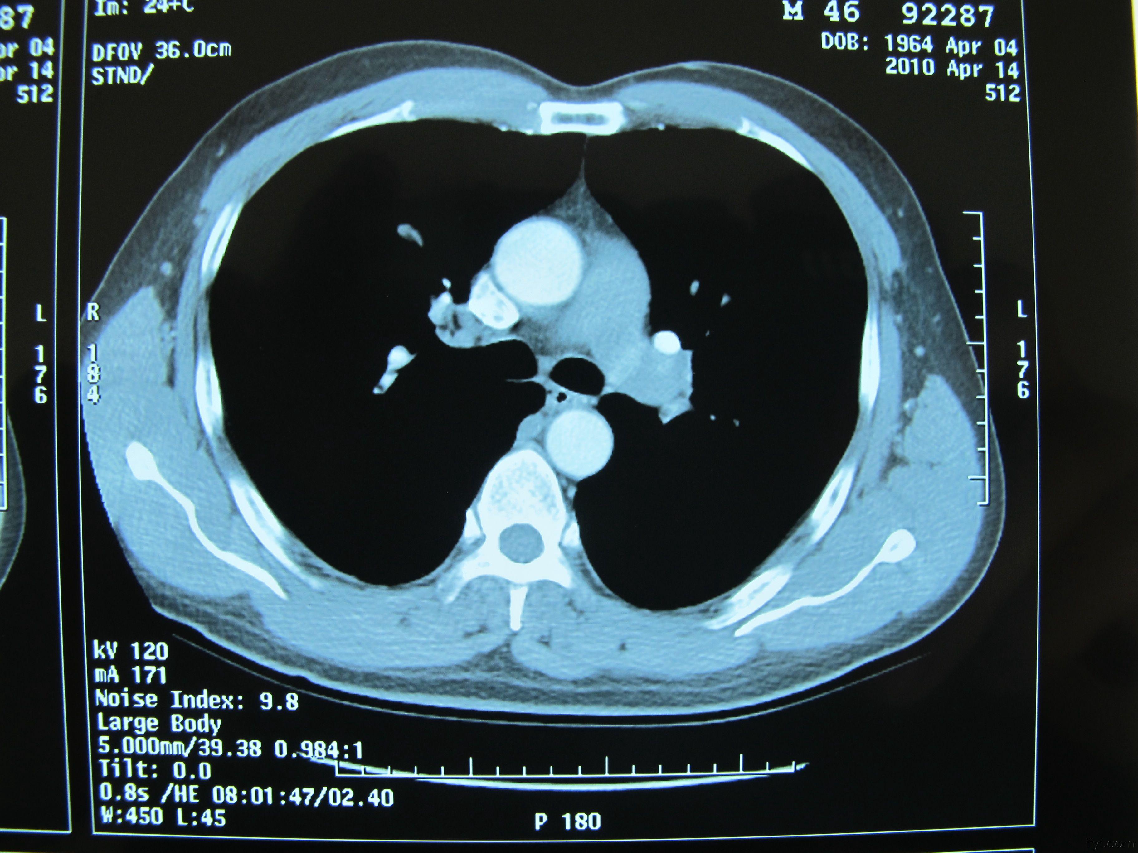 黑色素瘤术后转移灶