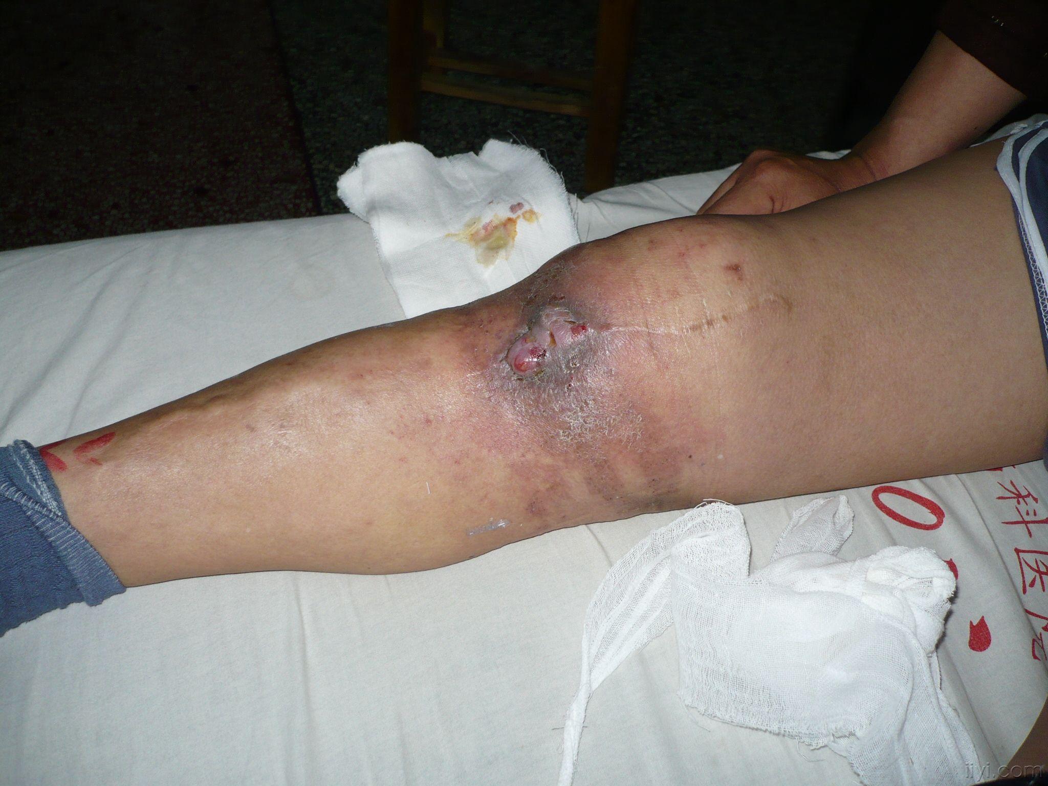 膝盖伤口感染化脓图片图片