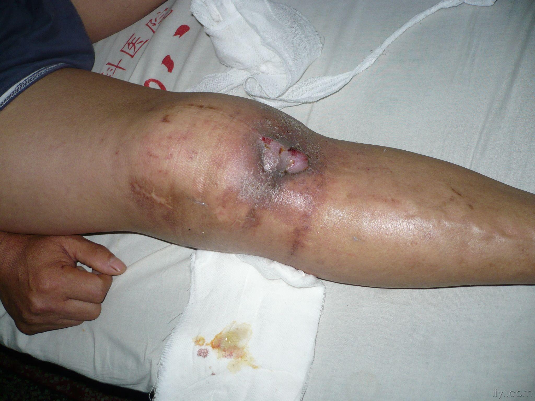膝盖伤口感染化脓图片图片