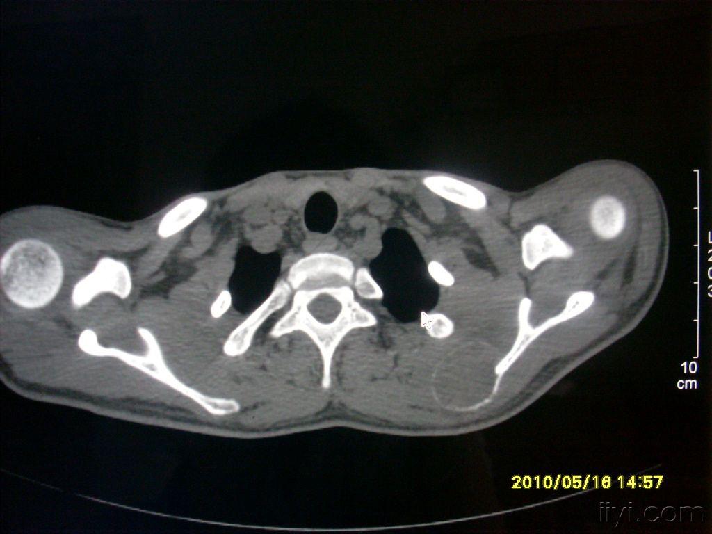 左肩胛骨病变