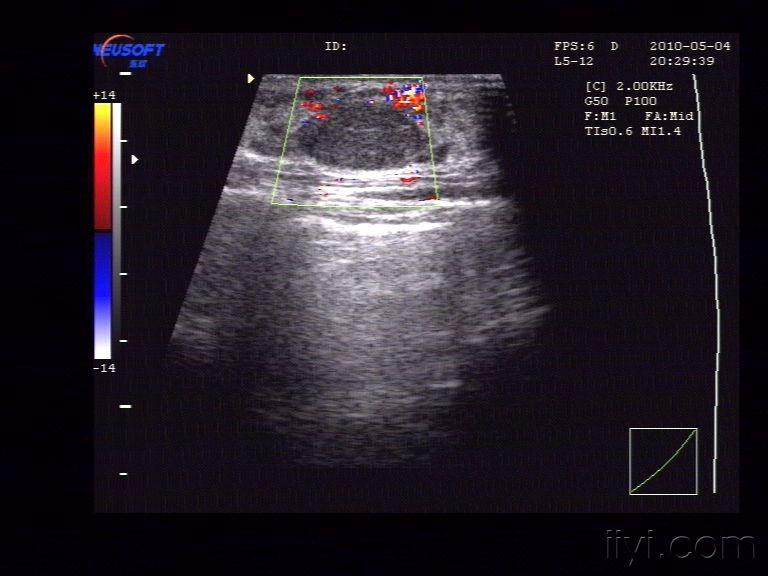 右乳纤维瘤 - 超声医学讨论版 - 爱爱医医学论坛