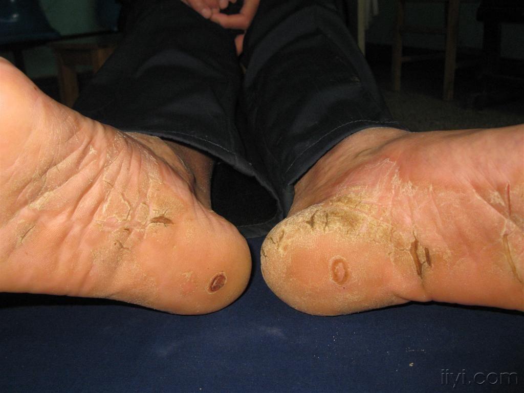 手足掌皲裂性皮损,局部角质增厚,不痒,有灼热感,5年.