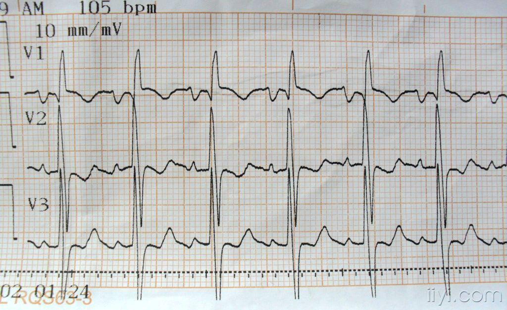 心电图脑电图专业讨论版 - 爱爱医医学论坛