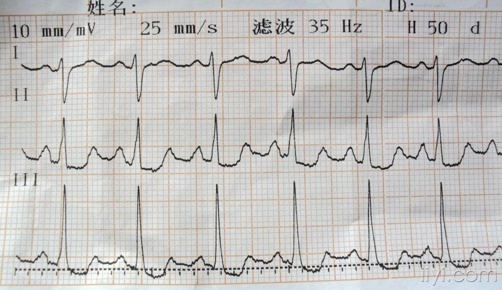 心电图脑电图专业讨论版 - 爱爱医医学论坛