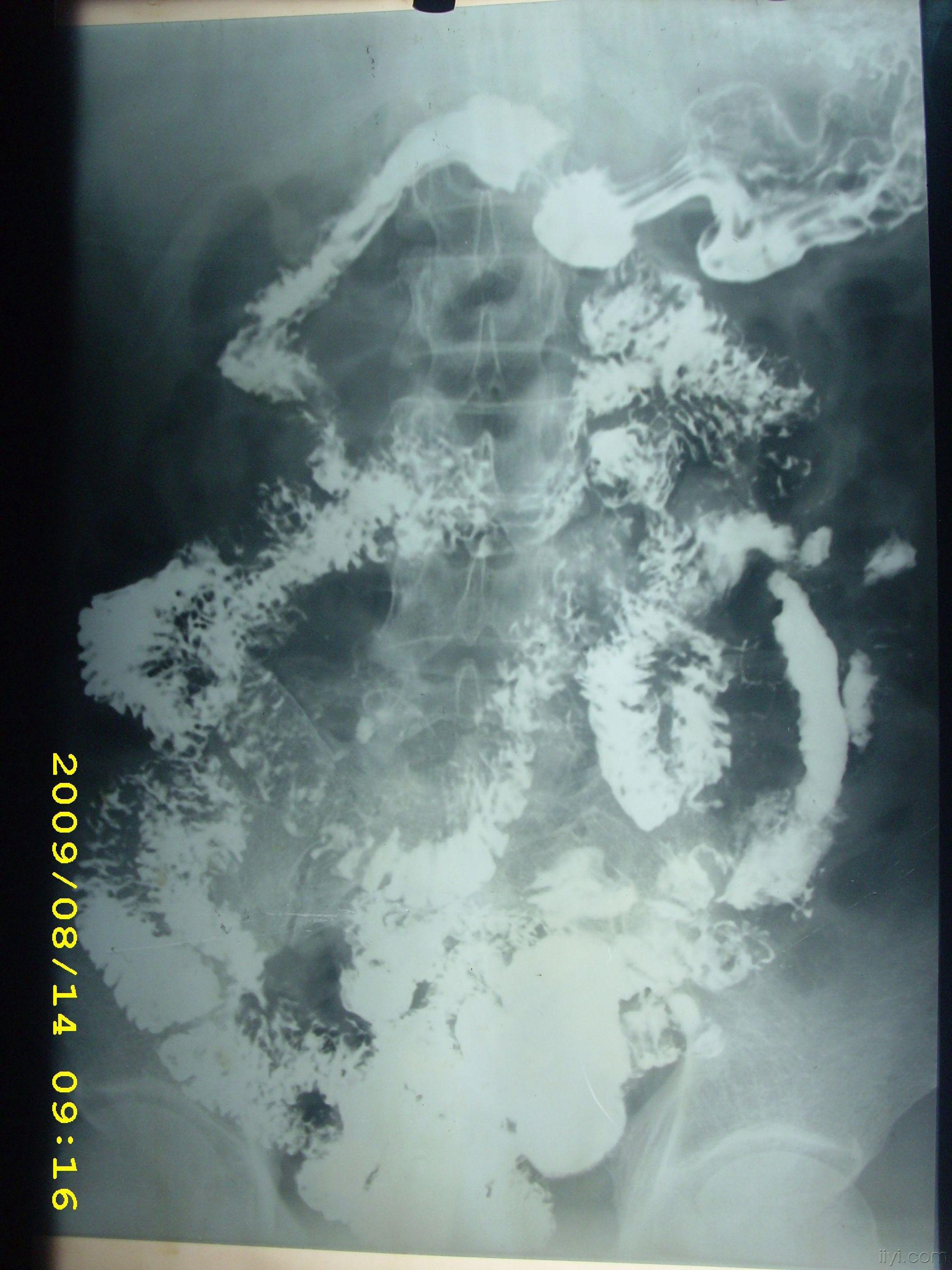 小肠钡剂造影请各位老师帮忙看片,急急急!