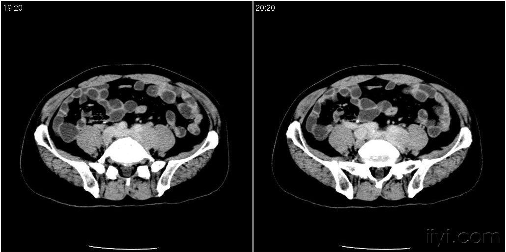 腹部病变/ct增强/20100520(因左侧肾盂积水,输尿管扩张进行ct检查)