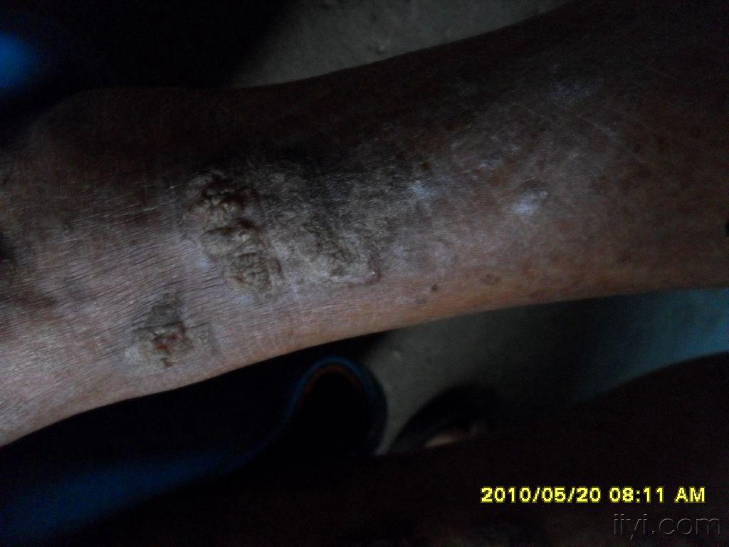 牛皮癣还是臁疮腿谢谢