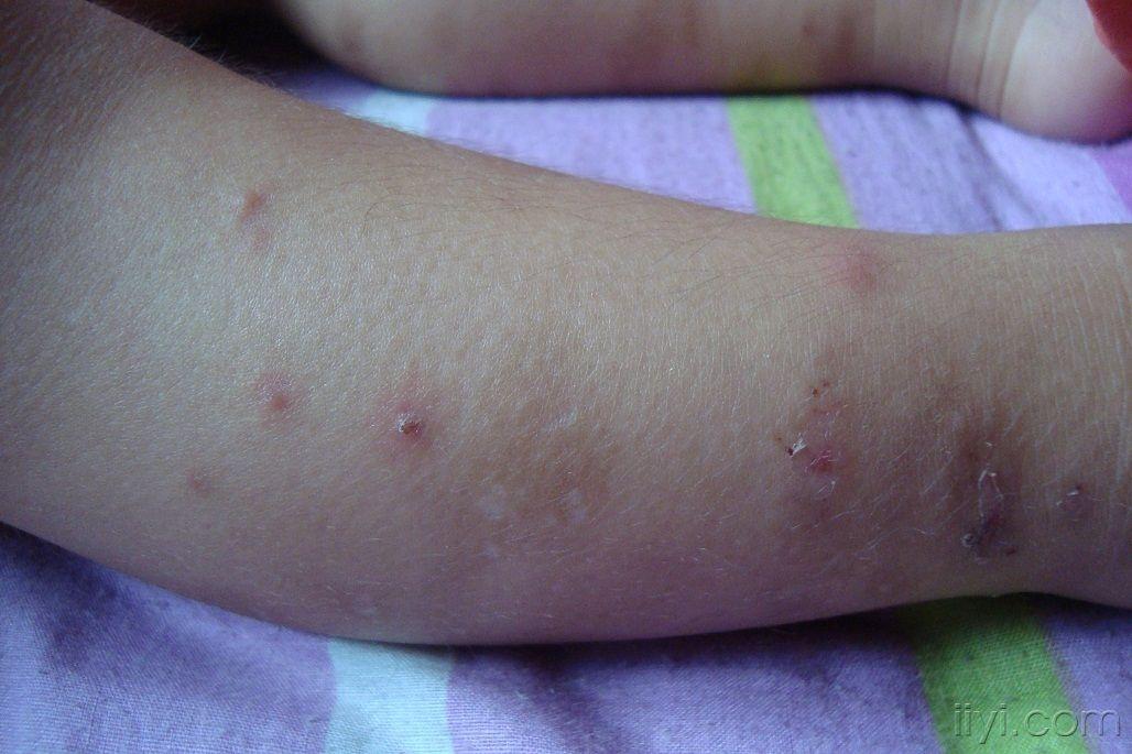小孩丘疹性荨麻疹图片