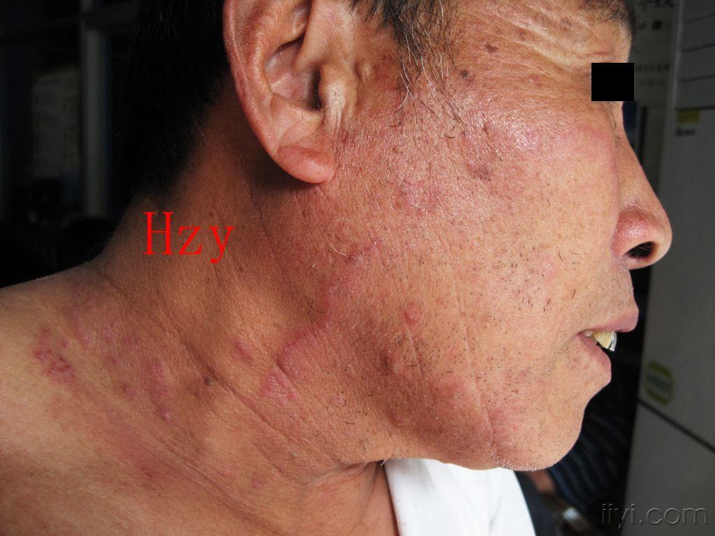 公布答案:体癣 - 皮肤及性传播疾病讨论版 - 爱爱医医学论坛