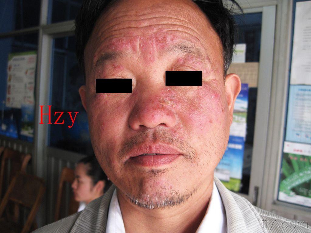 公布答案:脂溢性皮炎 - 皮肤及性传播疾病讨论版 - 爱爱医医学论坛