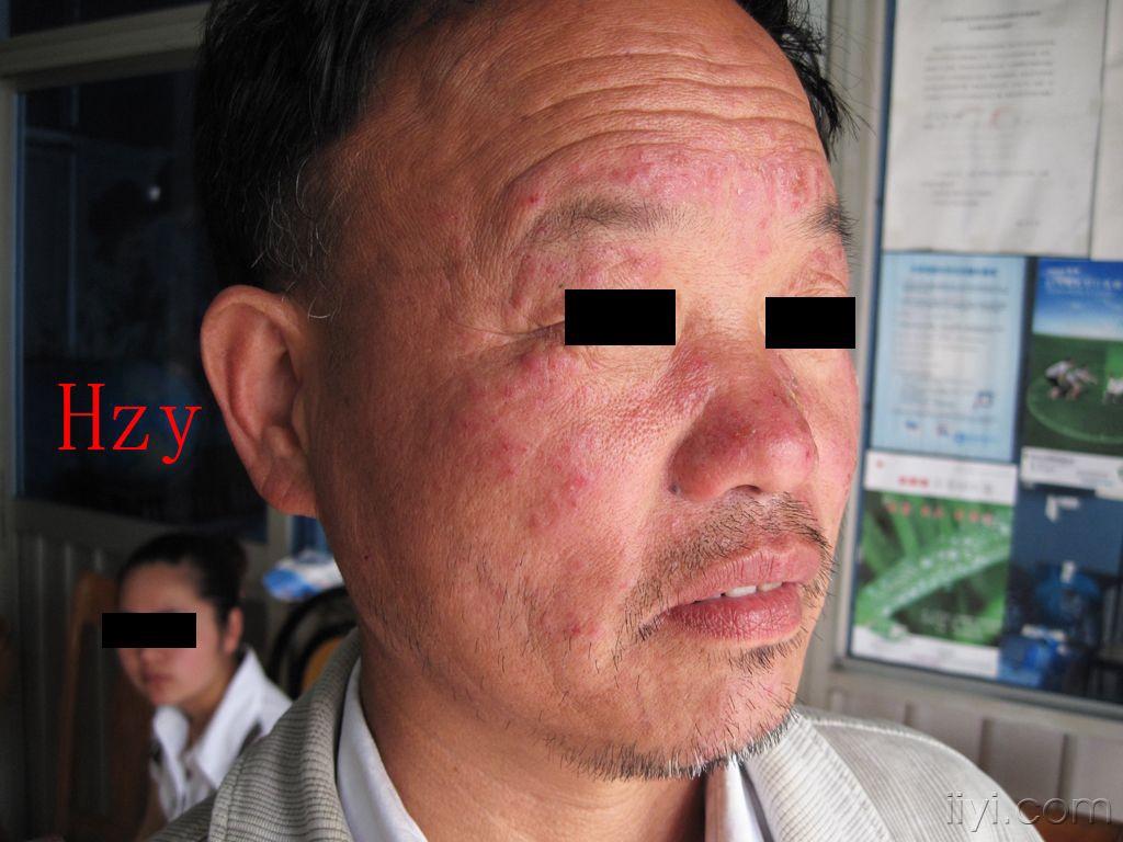脸上皮脂膜受损的图片图片