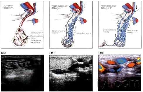 精索及精索静脉曲张