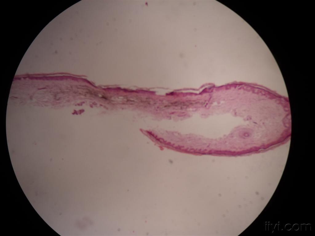 蓝痣一例附有病理