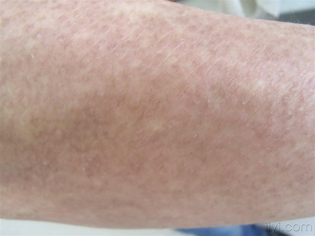 皮肤淀粉样变(有病理)