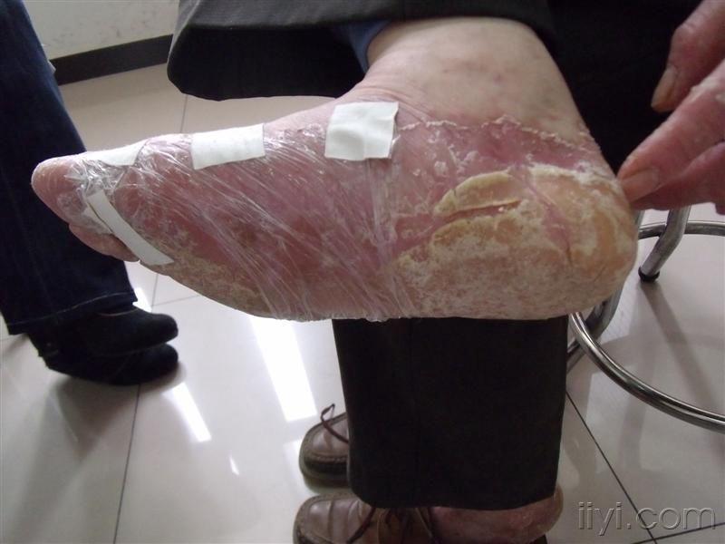 毛发红糠疹一例