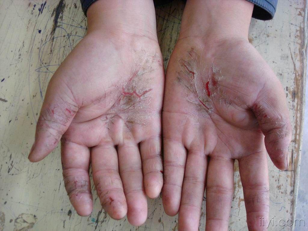 看图诊断湿疹皲裂型