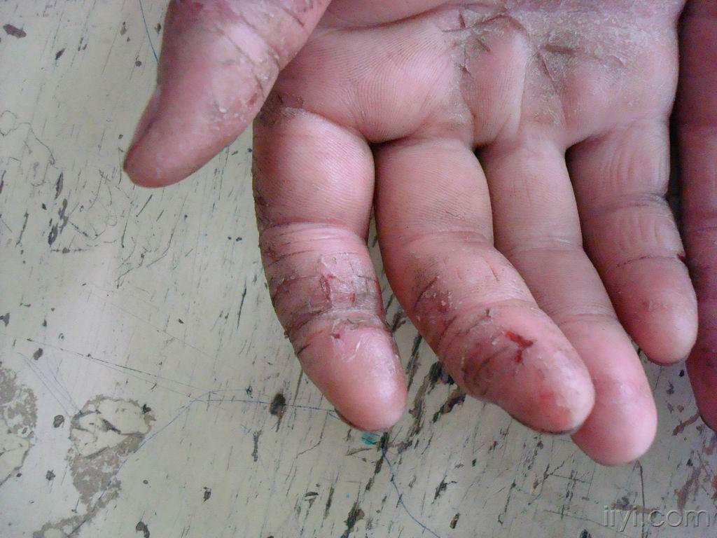 看图诊断……湿疹(皲裂型) - 皮肤及性传播疾病讨论版 - 爱爱医医学