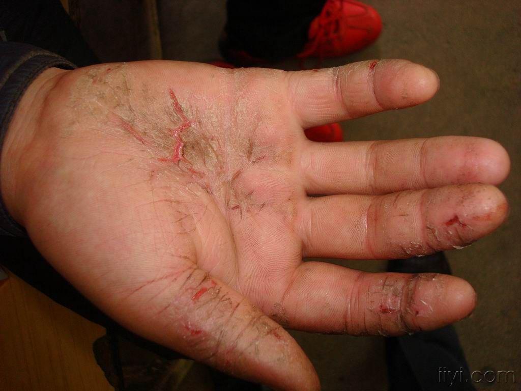 看图诊断湿疹皲裂型