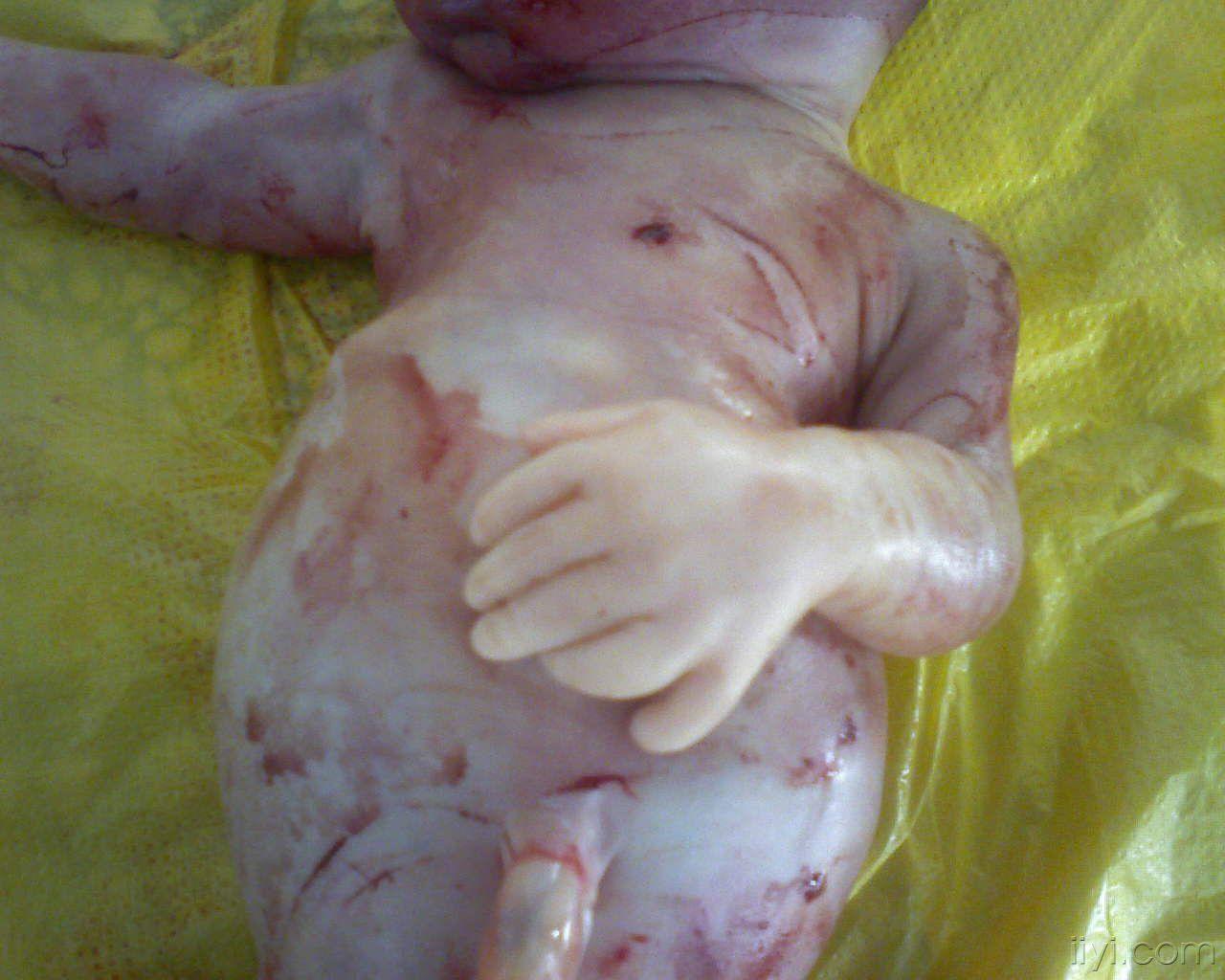 少见的胎儿六指畸形,同时存在骨发育不良!公布引产照片!