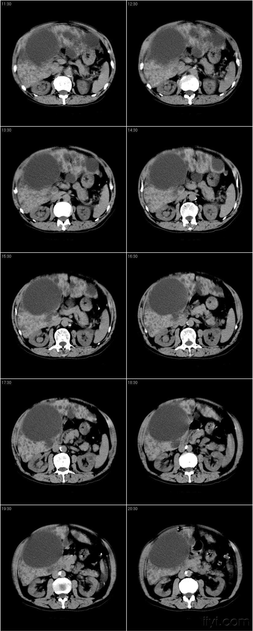多囊肝胆总管囊肿多囊肾