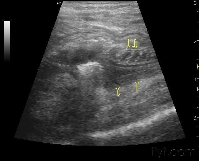 结肠肿瘤小肠套叠 - 超声医学讨论版 - 爱爱医医学论坛