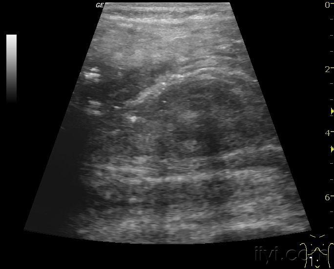 结肠肿瘤小肠套叠 - 超声医学讨论版 - 爱爱医医学论坛