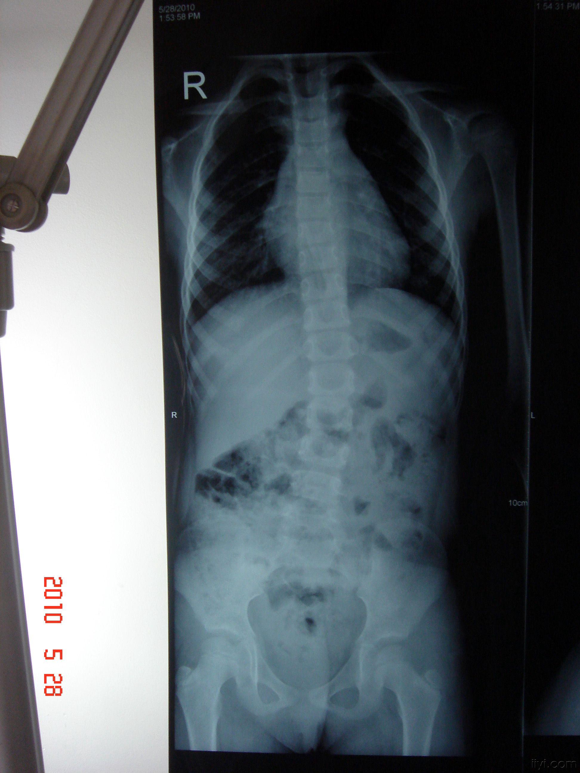 5岁儿童脊柱后凸图片