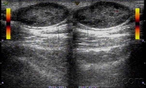 皮下脂肪瘤超声图片图片