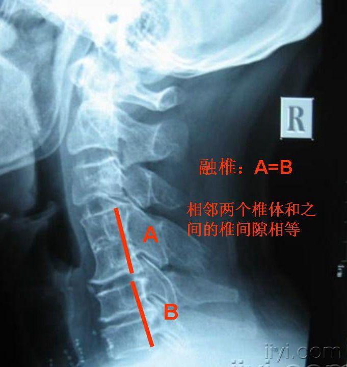 请各位老师给看个片子分析下这个颈椎片,谢谢了