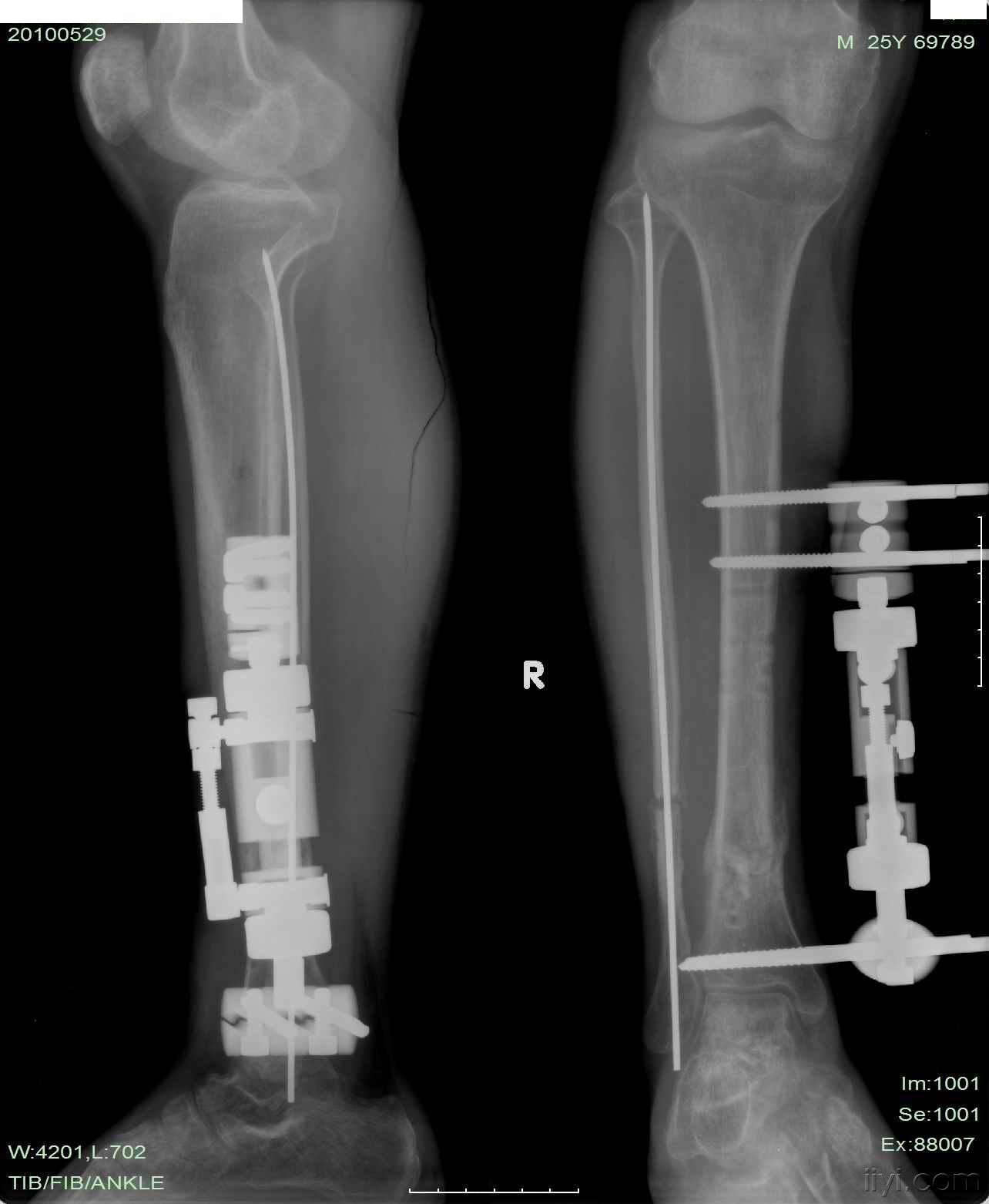 三例胫腓骨骨折并发症的处理 骨科与显微外科专业讨论版 爱爱医医学论坛
